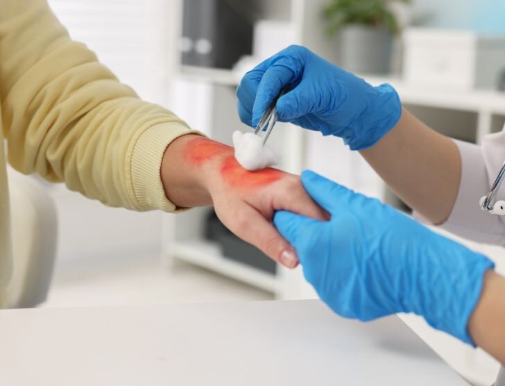 Czy za poparzenie należy się odszkodowanie?