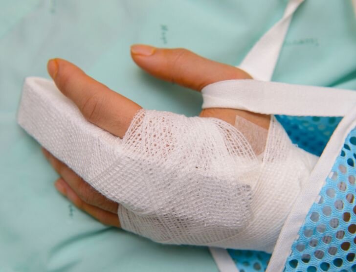 Ile wynosi odszkodowanie za złamany palec?